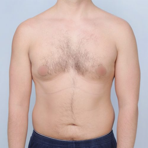 1A-61474_Ginekomastia_en-face_2023-09-21_16654-v2-aspect-ratio-500-500