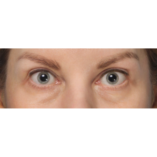 Michal10A-powieki-gorne-i-dolne-aspect-ratio-500-500