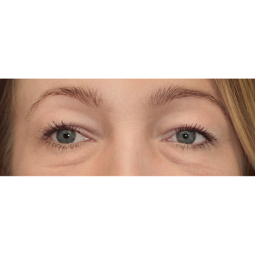 Michal11A-powieki-gorne-i-dolne-aspect-ratio-500-500