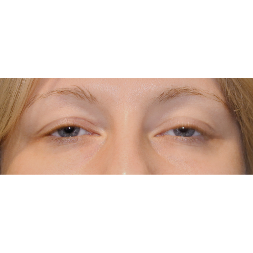 Michal1A-powieki-dolne-aspect-ratio-500-500