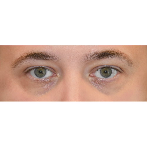 Michal2A-powieki-dolne-aspect-ratio-500-500