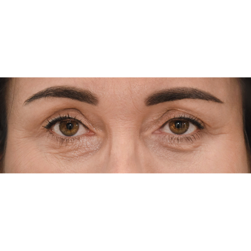 Michal9A-powieki-gorne-i-dolne-aspect-ratio-500-500