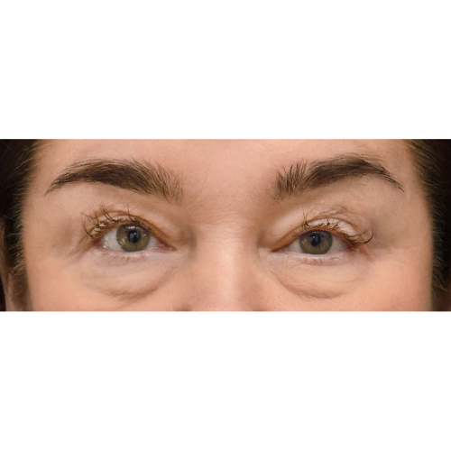 Michal8A-powieki-gorne-dolne-brwi-1-aspect-ratio-500-500