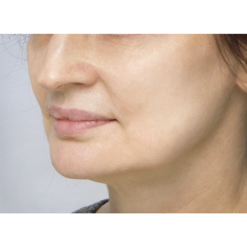 miszczyk-policzek-2AB-2A-aspect-ratio-500-500