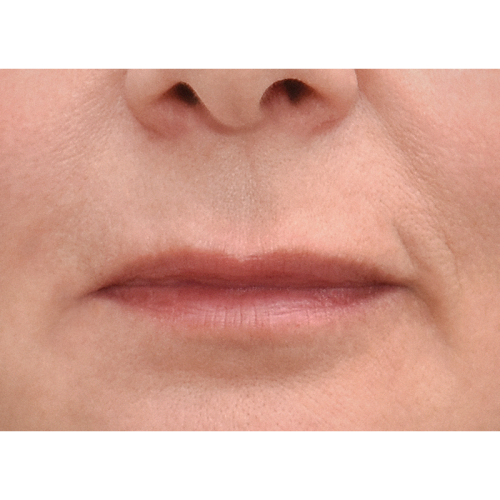 michal-lip-lift-1a-aspect-ratio-500-500
