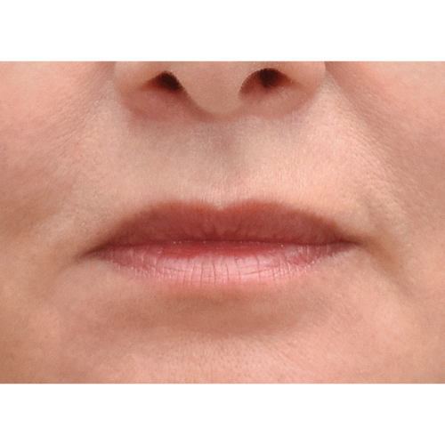 michal-lip-lift-1b-aspect-ratio-500-500