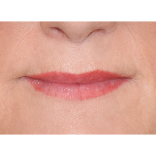 michal-lip-lift-2a-aspect-ratio-500-500