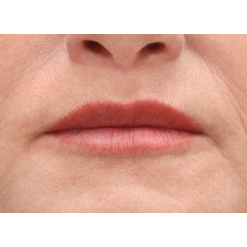 michal-lip-lift-2b-aspect-ratio-500-500