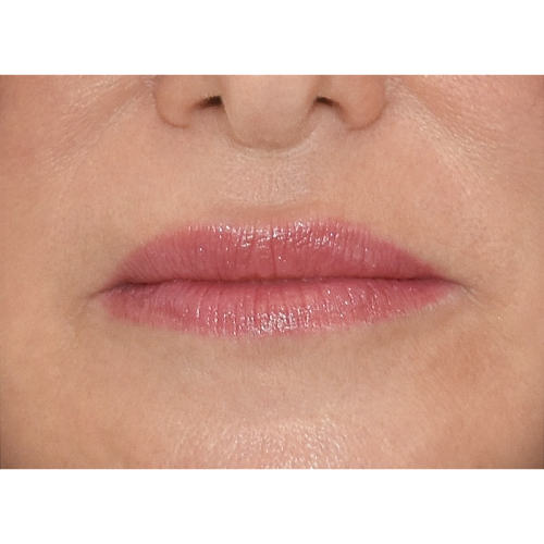 michal-lip-lift-3a-aspect-ratio-500-500
