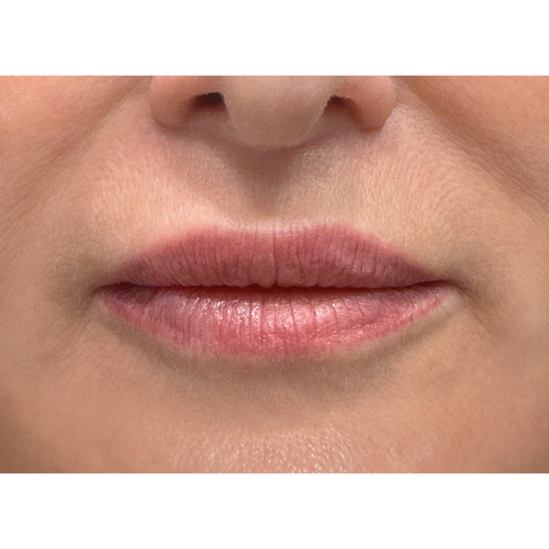 michal-lip-lift-3b-aspect-ratio-500-500