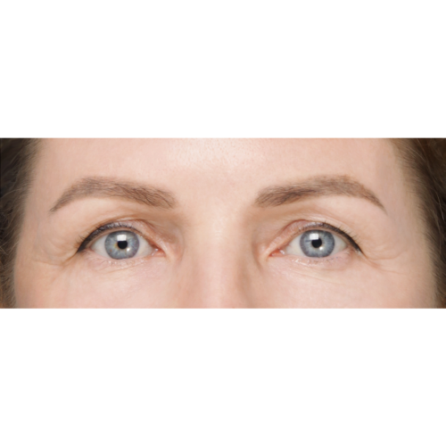 miszczyk-lift-brwi-policzek-9a-aspect-ratio-500-500