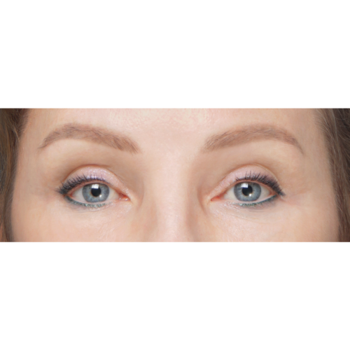 miszczyk-lift-brwi-policzek-9b-aspect-ratio-500-500