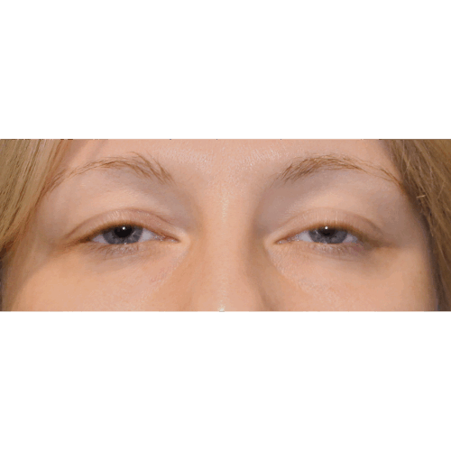 michal1a-powieki-dolne-aspect-ratio-500-500