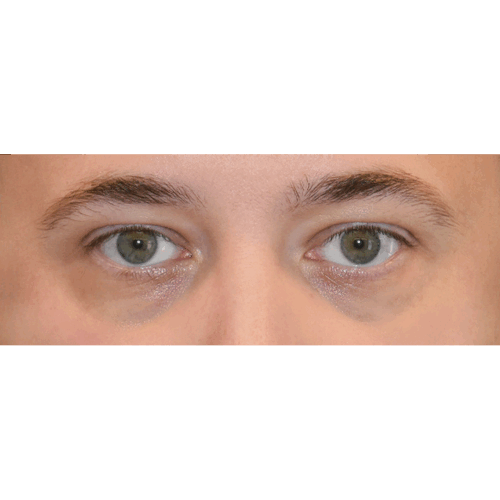 michal2a-powieki-dolne-aspect-ratio-500-500