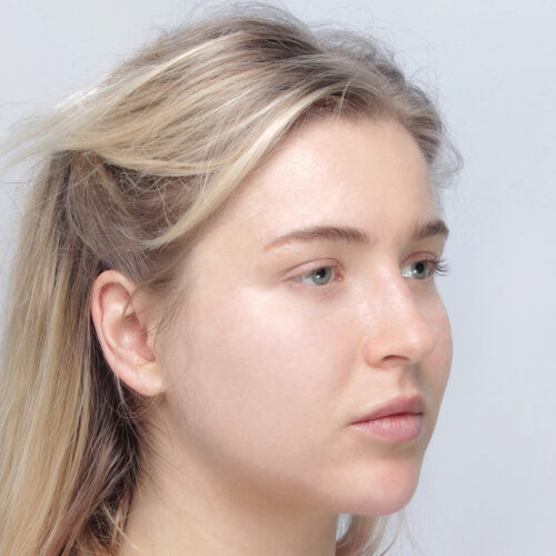 miszczyk-endo-midface-id69774-6c-aspect-ratio-500-500