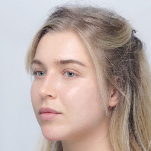 miszczyk-endo-midface-id69774-6e-aspect-ratio-500-500